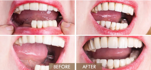 Before and After image of Replacing Teeth With Dentures in San Marcos California Area