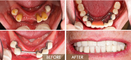 Fixed Bridges Before and After