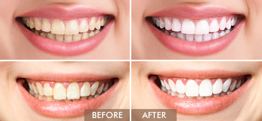 Teeth Whitening Before and After 01