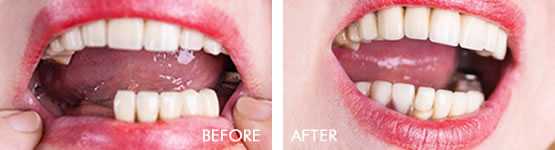 Dentures or Partial Dentures Before After 01