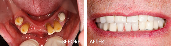 Dentures or Partial Dentures Before After 02
