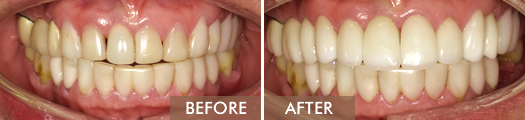 Porcelain Veneers Before and After 01