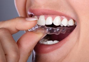 Why are invisible braces the right choice?