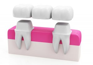Dental Bridges Near Me San Marcos Area