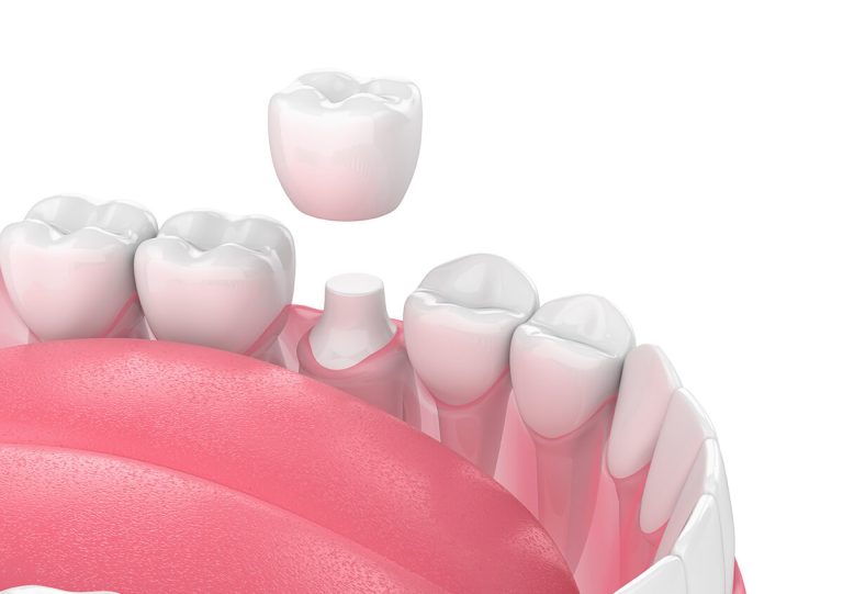 Cosmetic Dental Crowns in San Marcos CA Area