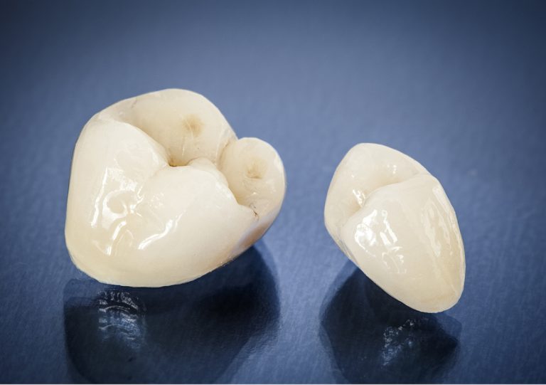 Natural Looking Crowns in San Marcos CA Area