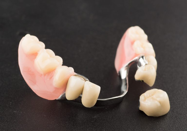Partial Denture for One Tooth in San Marcos CA Area