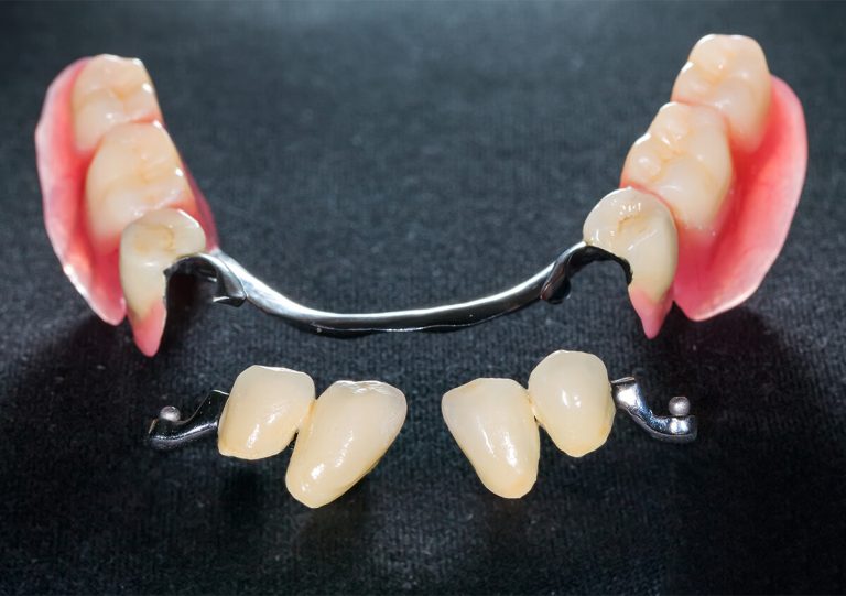 Partial Dentures in San Marcos CA Area