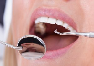 Periodontal Pocket Treatment in San Marcos California Area