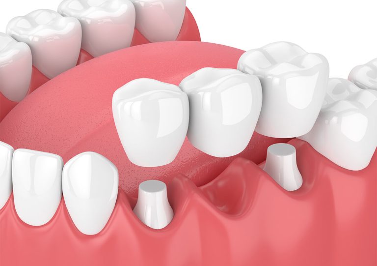 Permanent Bridges for Teeth in San Marcos California Area