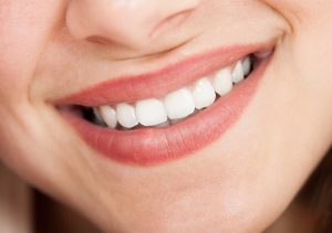 Porcelain Veneers Benefits in San Marcos CA Area