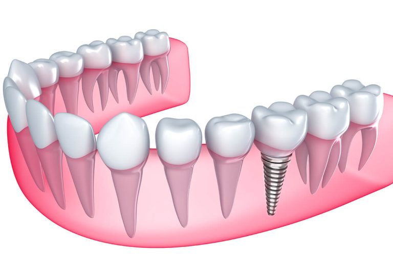 https://shadowridgedentists.com/teeth-implants-san-marcosca/