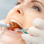 Tooth Decay Restoration in San Marcos CA Area
