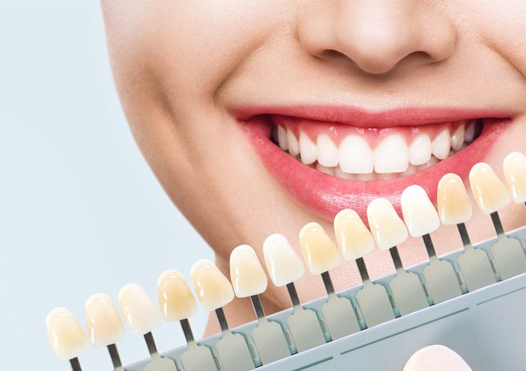 Veneers for Enamel Loss in San Marcos CA Area