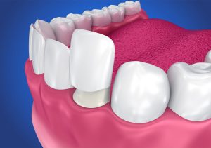 Veneers for Overlapping Teeth in San Marcos CA Area