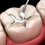 Dental Cavity Filling Procedure in San Marcos CA Area