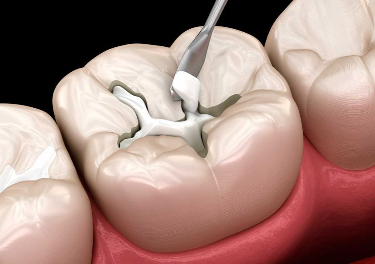 Dental Cavity Filling Procedure in San Marcos CA Area