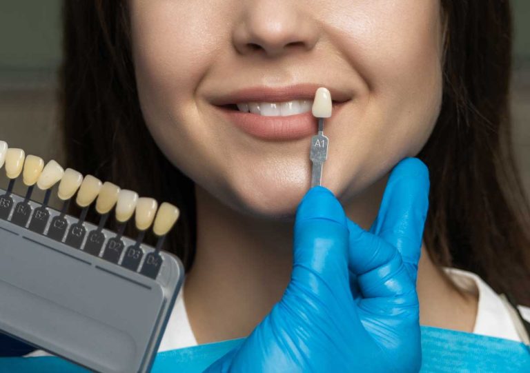 Veneers in San Marcos, CA Area