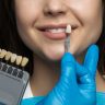 Veneers in San Marcos, CA Area
