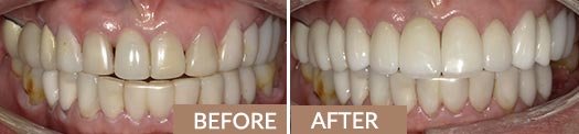 Teeth Veneers Before and After