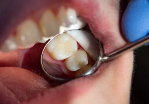 Composite filling dentist near San Marcos, CA