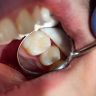 Composite filling dentist near San Marcos, CA