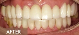 after porcelain veneers