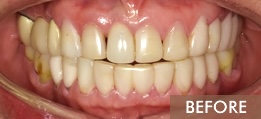 before porcelain veneers